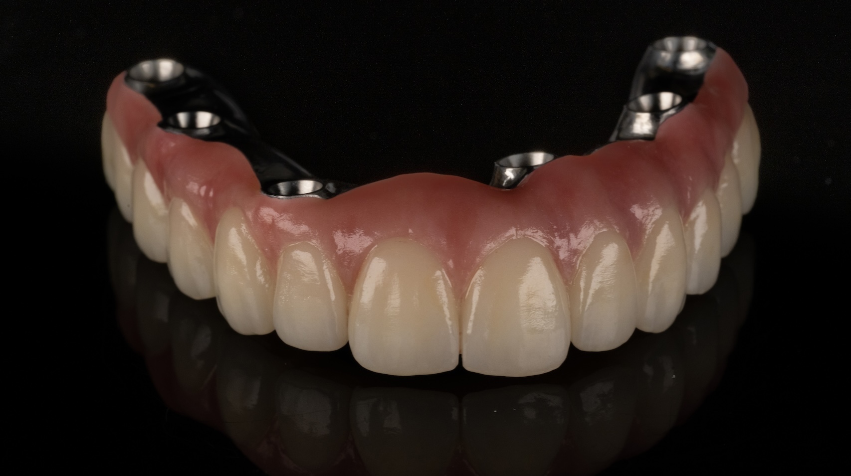 Full Arch Implant Bridge