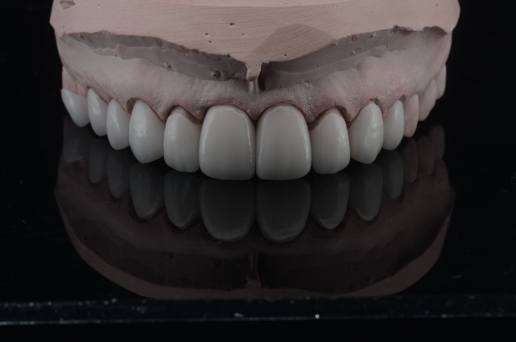 Full Contour Zirconia