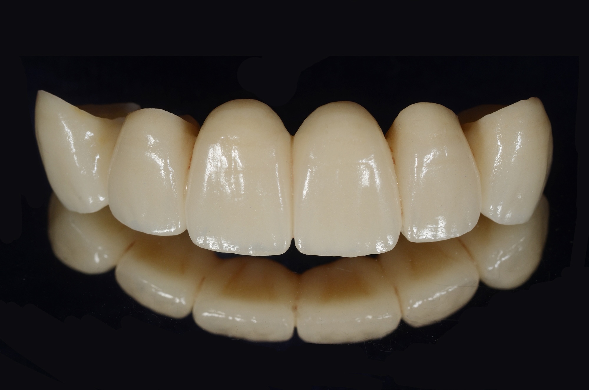 Full Contour Zirconia