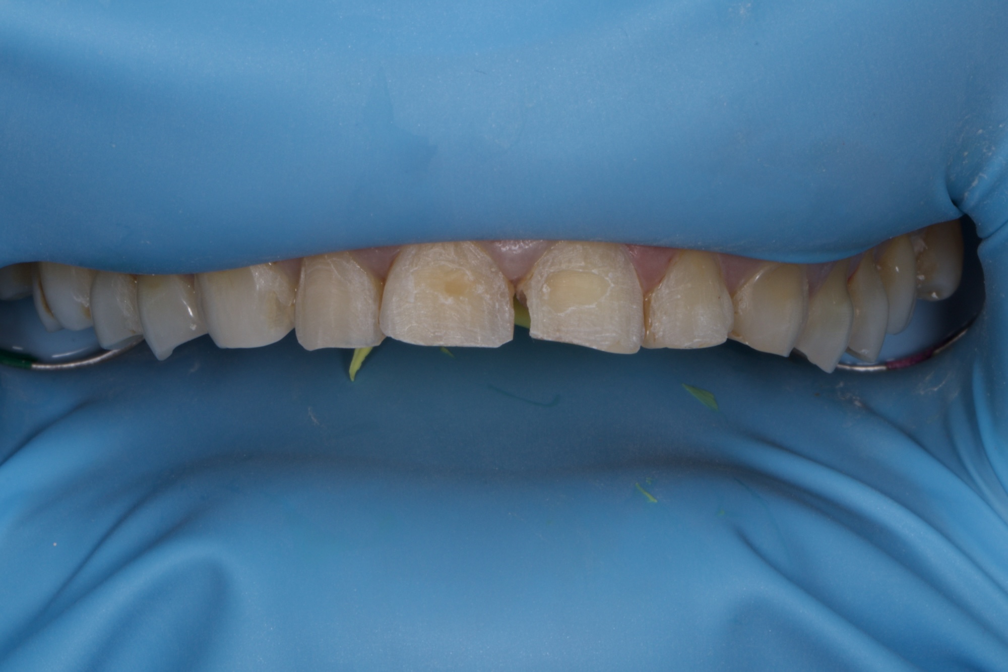 Models & Matrix for Injectable Technique