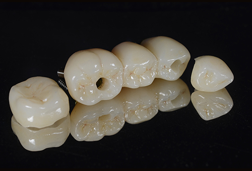 Implant Restorative