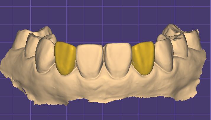 Digital Wax-up