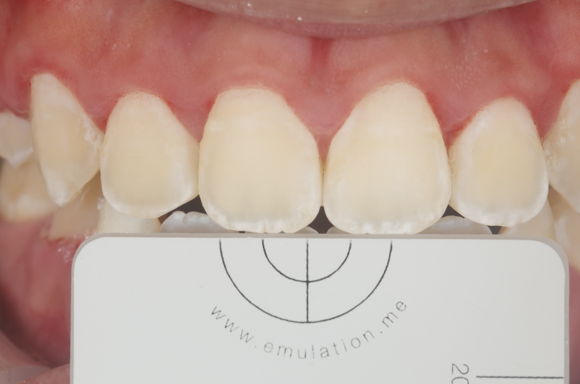 e.LAB Shade Matching